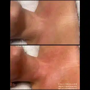 Raffermissement cou et decolleté