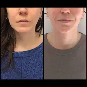 correction asymétrie de visage