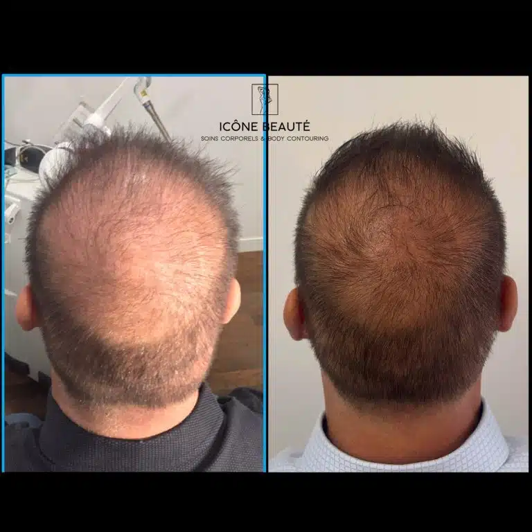 Densification Capillaire Tête Complète