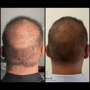 Densification Capillaire tête complète