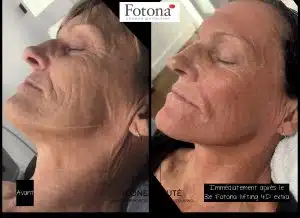 2D extra fractionné licalisé